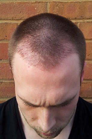 Cheap Hair Transplants in Istanbul