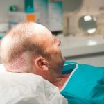 Everything You Need to Know About Hair Transplants in Chicago