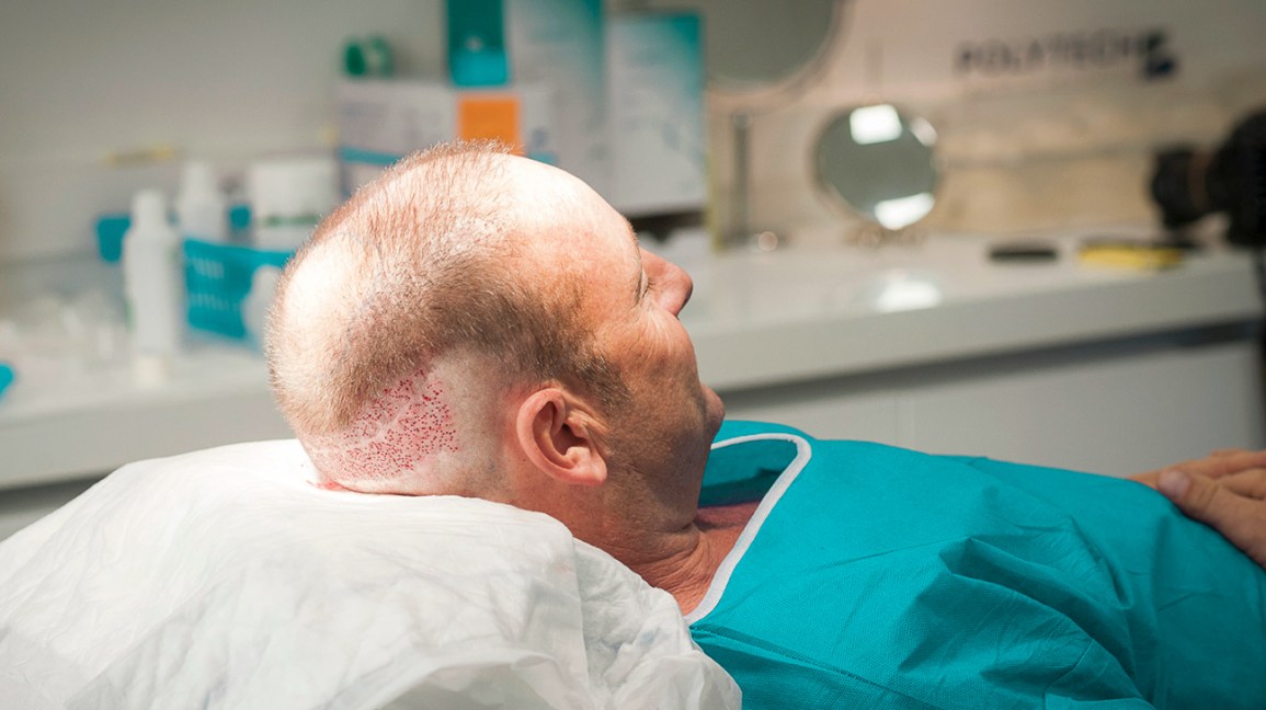 Everything You Need to Know About Hair Transplants in Chicago