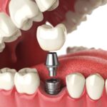 CheapOral Implants Abroad