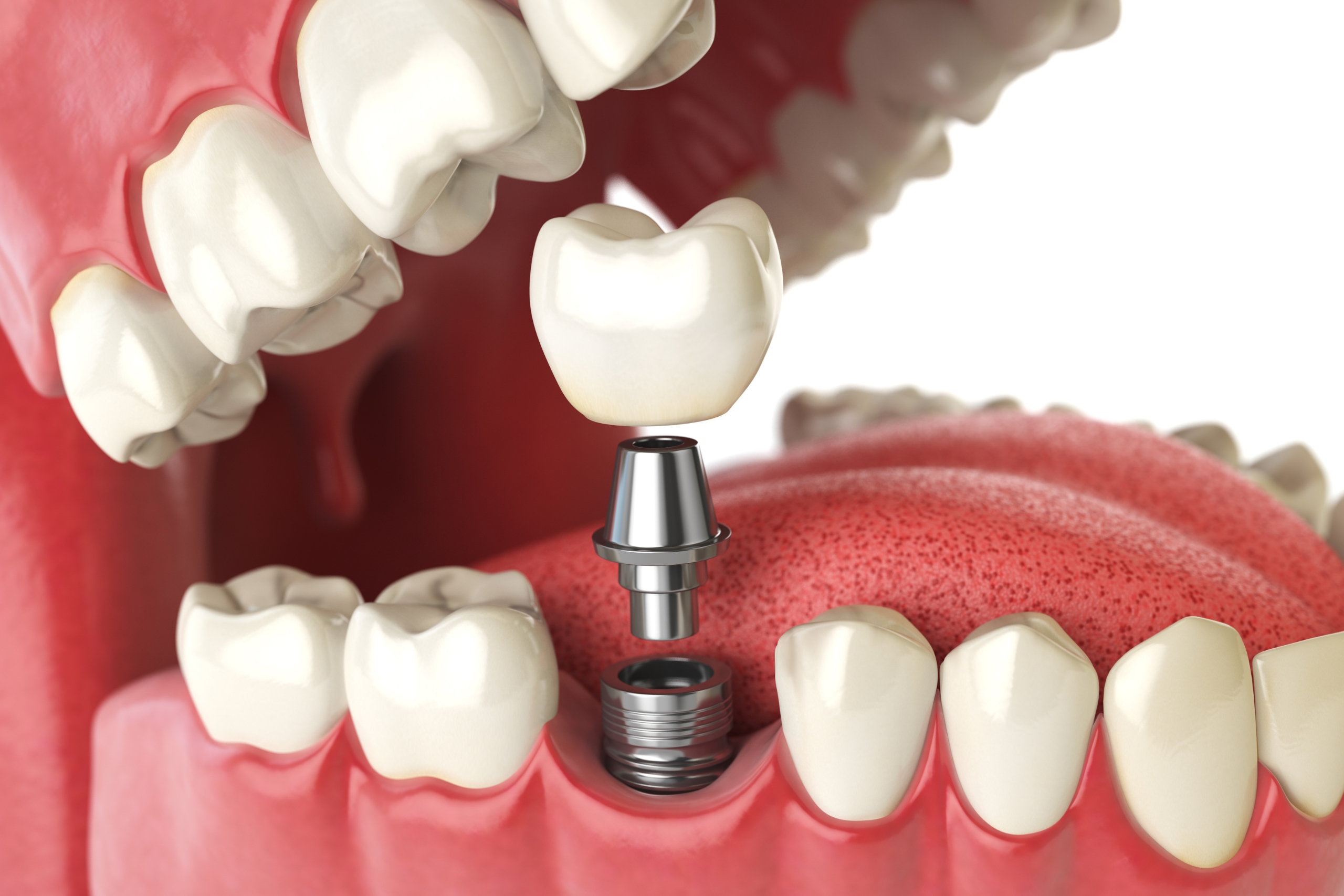 CheapOral Implants Abroad