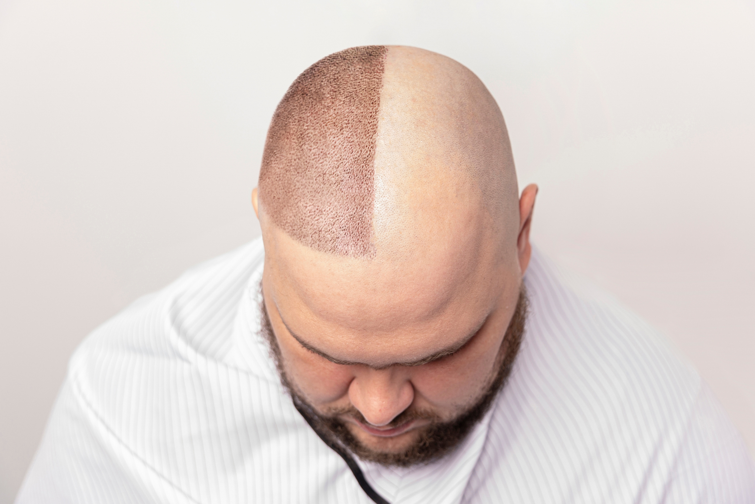 Hair Transplant Success Rate in Turkey