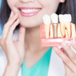 Oral Implants in Typically the Best Countries to be Able to Have Dental Implants Abroad in 2023